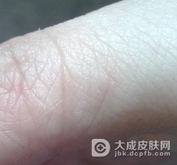 手部汗疱疹具体症状是什么