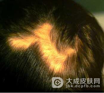 假斑秃治好后，还会长头发吗