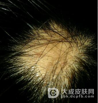假性斑秃和斑秃的区别是什么呢