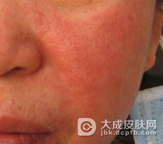 药物性皮炎是怎么发病
