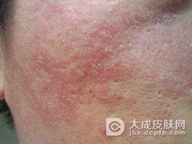 药物性皮炎应该如何进行治疗呢