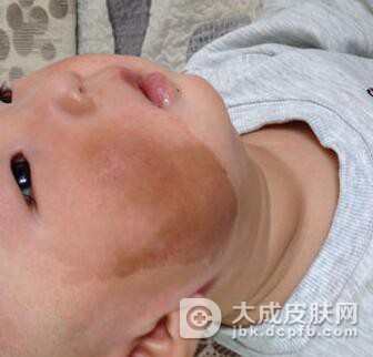 咖啡斑对身体有什么影响