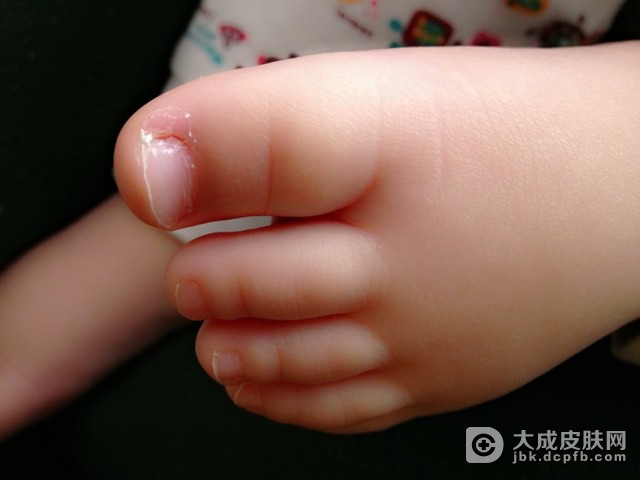 甲沟炎健康保健常识