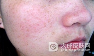 雀斑对女性有什么危害