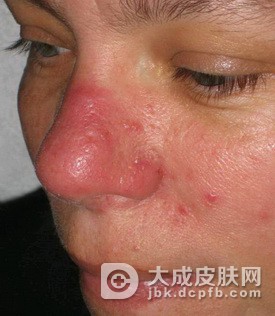酒槽鼻有什么危害