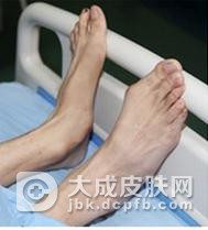 趾断症应当怎么的治疗