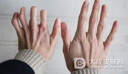 趾断症有什么样的症状表现