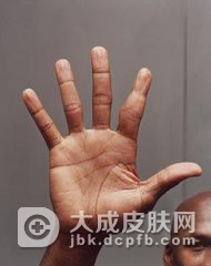 趾断症有哪些的症状表现