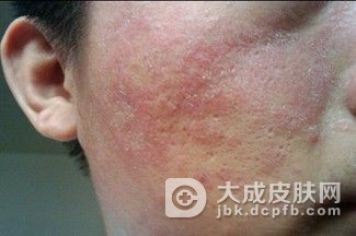 异位性皮炎如何治疗