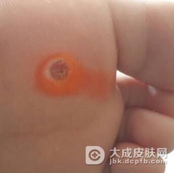 脚上长了鸡眼应该怎么治疗呢