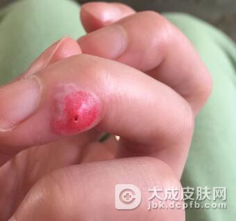 鸡眼的形成原因是什么呢
