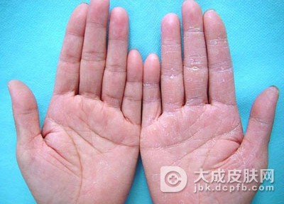手足皲裂的预防主要有哪些方法
