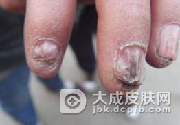 肠病性肢端皮炎的治疗都应注意什么