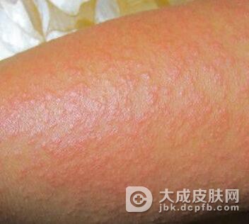 日光性皮炎的危害都有哪些呢