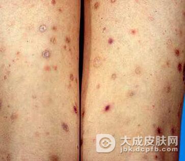 如何自我分析副银屑病