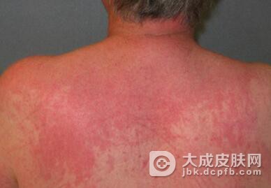 皮肌炎有哪些伤害有哪些吧