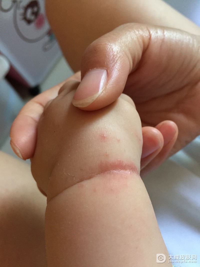 婴儿患上湿疹有哪些症状