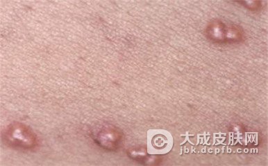 黄瘤病的临床类型是什么