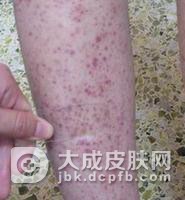 特发性血小板减少性紫癜到底是什么病