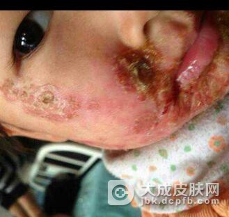 脓包疮的病因及预防有哪些