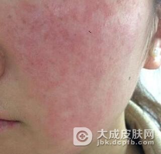 应该怎么护理皮肤过敏