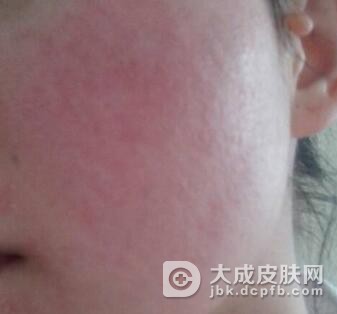 女性怀孕时皮肤过敏怎么办