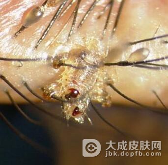 阴虱病的临床表现是怎么样的