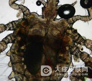 应该要如何预防阴虱病呢