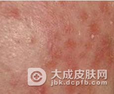 传染性湿疹样皮炎的诱因是什么吗