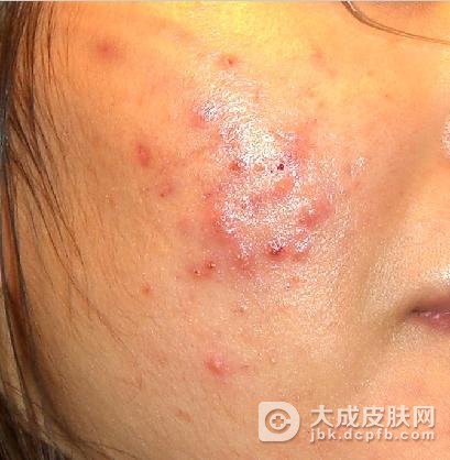 青春痘危害会是什么