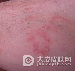 传染性湿疹样皮炎有哪些的皮损特点