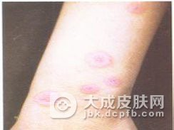 是什么导致了硬红斑的发病
