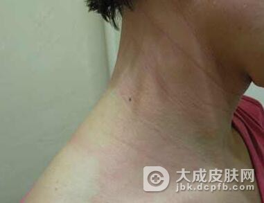 过敏性皮炎的并发症有哪些