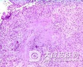 硬红斑的发生应怎样预防