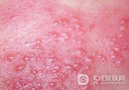 男人是何原因患上生殖器疱疹？