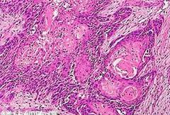 鳞状细胞癌病情发展及体现