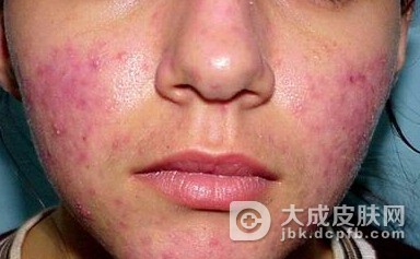 如何更好的预防酒渣鼻