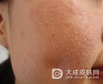 玫瑰糠疹有哪些护理事项