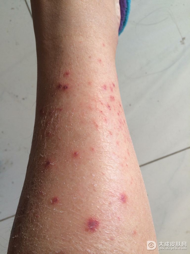 传染性红斑症状是什么
