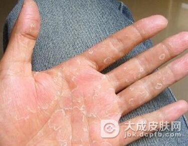 怎样进行手癣的治疗