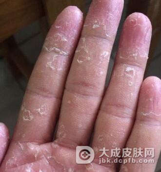手癣患者怎样护理才会有效