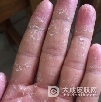 手癣患者应不应该下厨