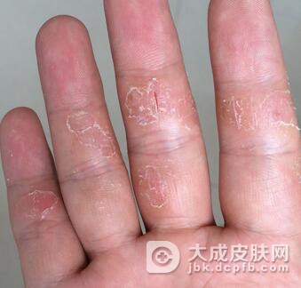 手癣的症状是什么样子的呢