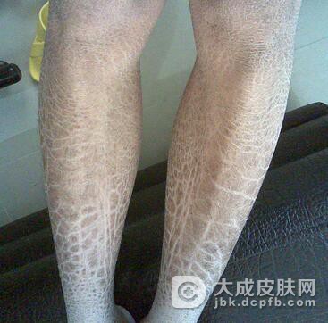 生活中鱼鳞病要怎么护理