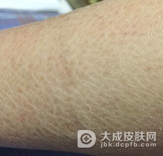 鱼鳞病能吃碱性食物吗