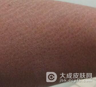 不同阶段的鱼鳞病应该怎么治疗