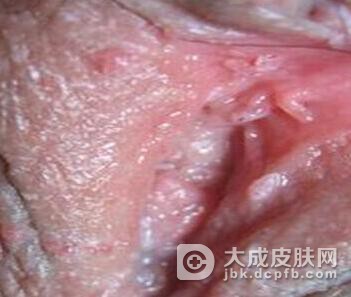 女性尖锐湿疣好发部位有哪些呢
