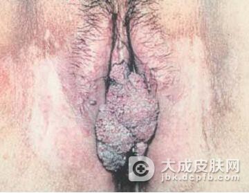 女性尖锐湿疣的传播途径有几种呢