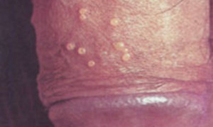 生殖器疱疹的危害有哪些