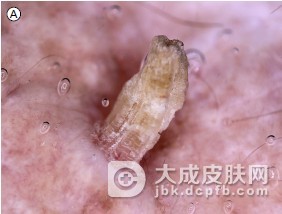 引起皮肤角化的原因是什么